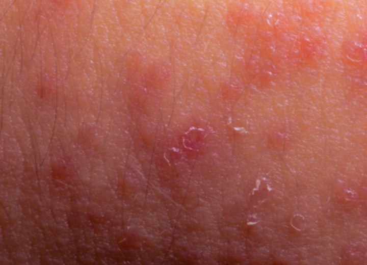 Huid met dermatitis