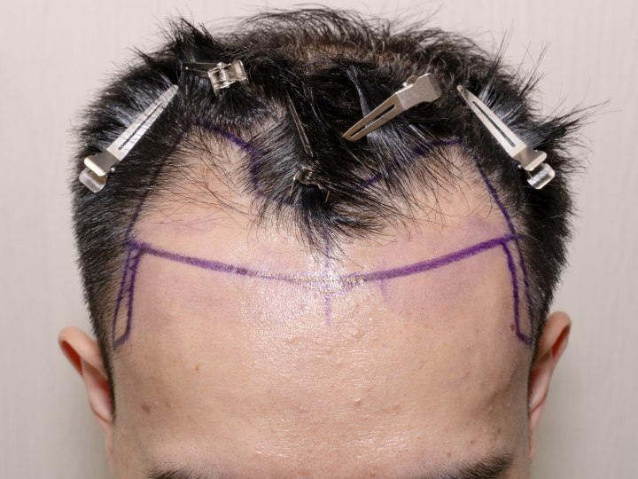 Man met getransplanteerd haar