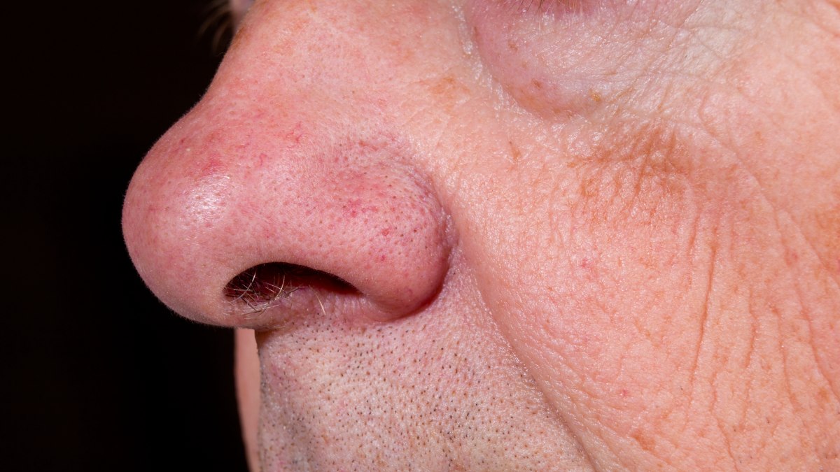 Красный нос у мужчины. Гипертрофическая ринофима.