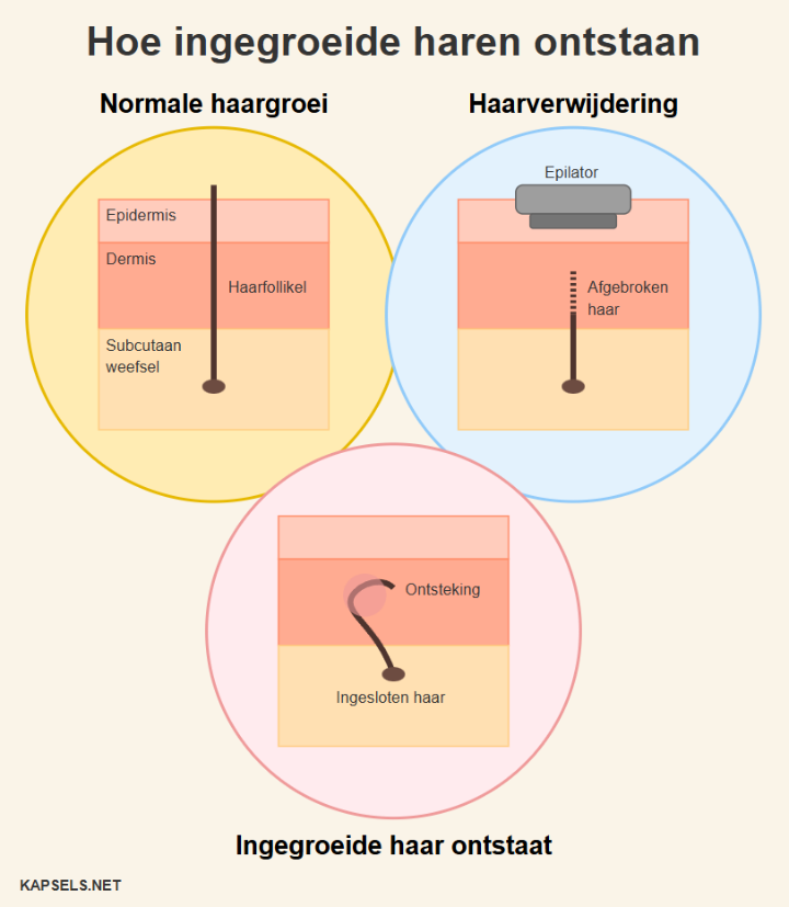 Infografiek - Hoe ingegroeide haren ontstaan